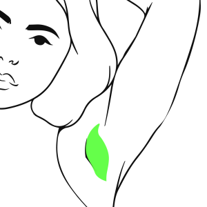 Excessive Sweating Treatment