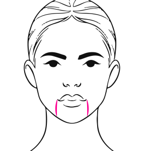 Corner of the Mouth Filler