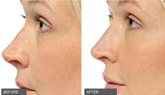 nose-filler