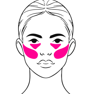Tear Trough and Cheek Filler